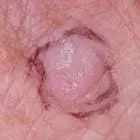 Actinic keratosis: a rough, scaly pink patch with a darker rim on sun-exposed skin