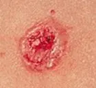 Basal cell carcinoma: a pink-red lesion with a crusted, uneven surface on the skin