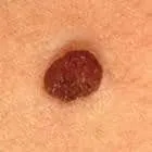 Dysplastic nevus: a dark brown mole with an uneven, slightly irregular surface