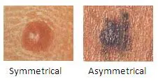 Two moles compared: a symmetrical one labeled Symmetrical and an irregular dark one labeled Asymmetrical