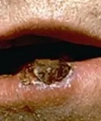 Squamous cell carcinoma: a crusted, scaly growth on the lower lip