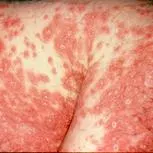 Erythrodermic psoriasis: widespread red, inflamed skin with scattered scaly patches