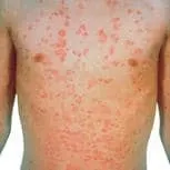 Guttate psoriasis: many small, round, red drop-shaped spots scattered across the chest and abdomen