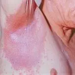 Inverse psoriasis: a smooth, red, well-defined patch in the underarm skin fold