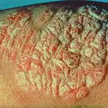 Plaque psoriasis: a thick, raised patch of red skin with scale