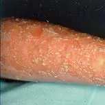Pustular psoriasis: red skin on a lower leg dotted with small pale pustules and scale