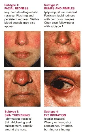 Four rosacea subtypes shown on faces: facial redness, bumps and pimples, skin thickening of the nose, and eye irritation