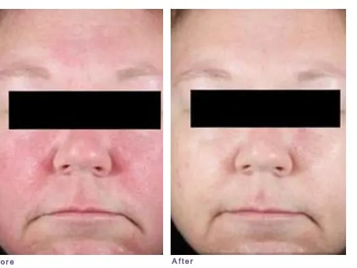 Rosacea before and after: a face with widespread cheek and nose redness, then visibly calmer, clearer skin