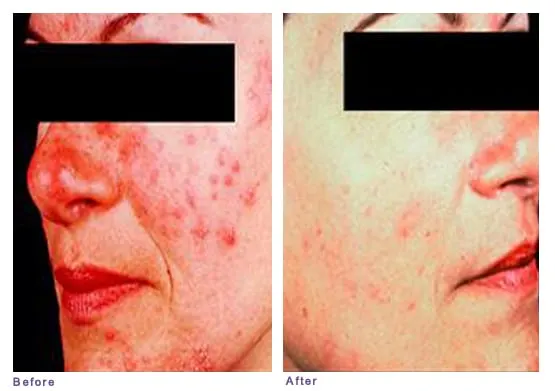 Rosacea before and after: red bumps and flushing on the cheek and nose, then much less redness afterward
