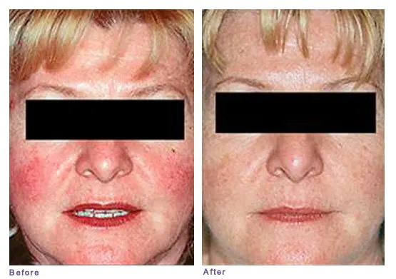 Rosacea before and after: red flushed cheeks on a woman's face, then an even, lighter skin tone