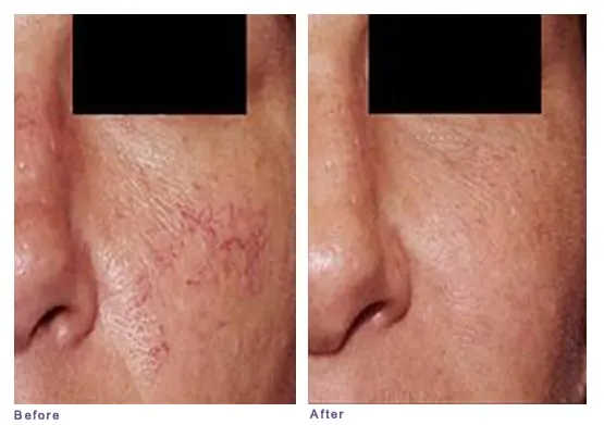 Rosacea before and after: visible small red blood vessels on the cheek, then clear skin