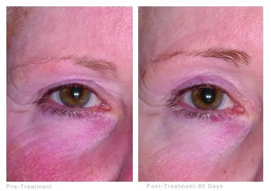 Ultherapy before and after: the skin around a woman’s eye before treatment and 90 days after