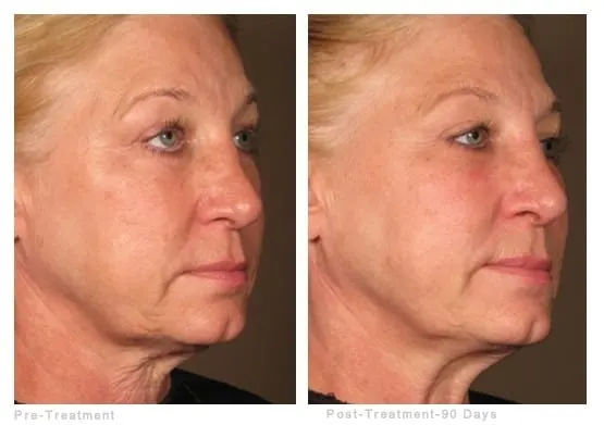 Ultherapy before and after: a woman’s jawline and neck before treatment and 90 days after