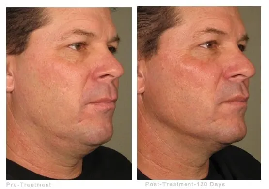 Ultherapy before and after: a man’s jawline in profile before treatment and 120 days after