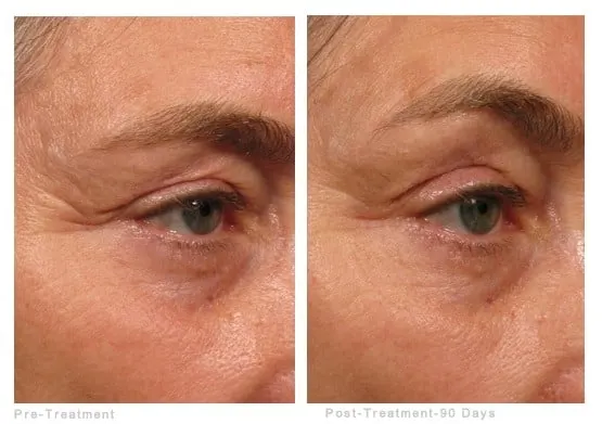 Ultherapy before and after: the brow and eyelid area before treatment and 90 days after