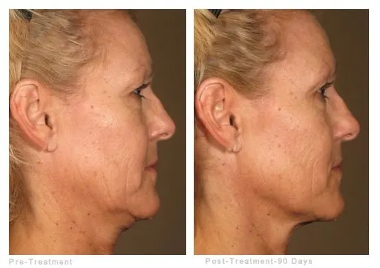 Ultherapy before and after: a woman’s cheek and jaw in profile before treatment and 90 days after