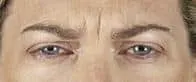 woman's brow with frow line