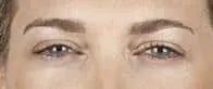 woman’s brow after xeomin, fewer lines after treatment