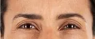 woman’s brow after xeomin, fewer lines after treatment
