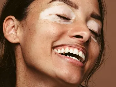 A smiling woman with eyes closed and pale depigmented patches of skin around her eyes, against a brown backdrop