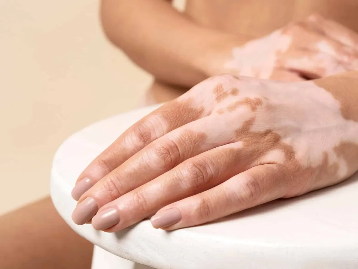 A woman's hands resting on a white table, with pale vitiligo patches on the skin