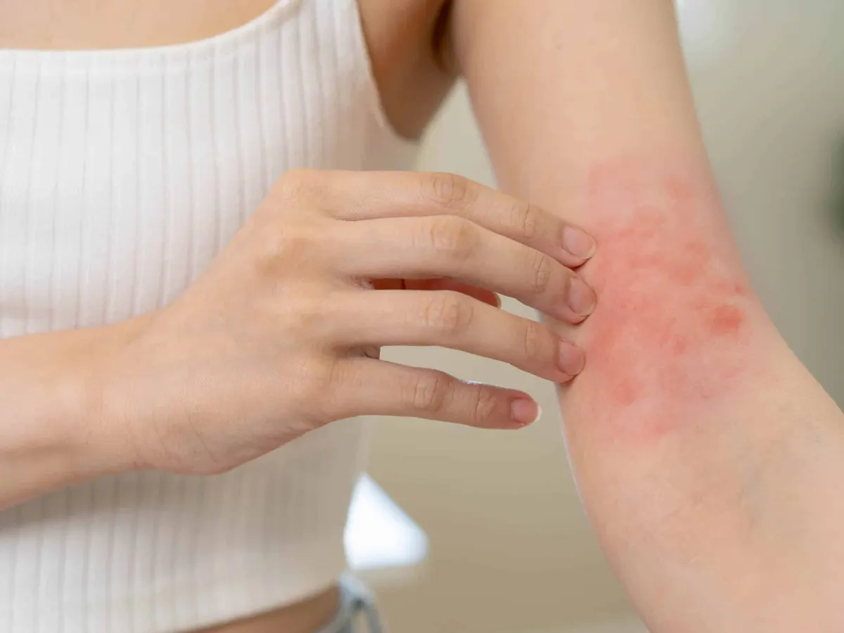 Asian young woman, girl hand in her arm allergy