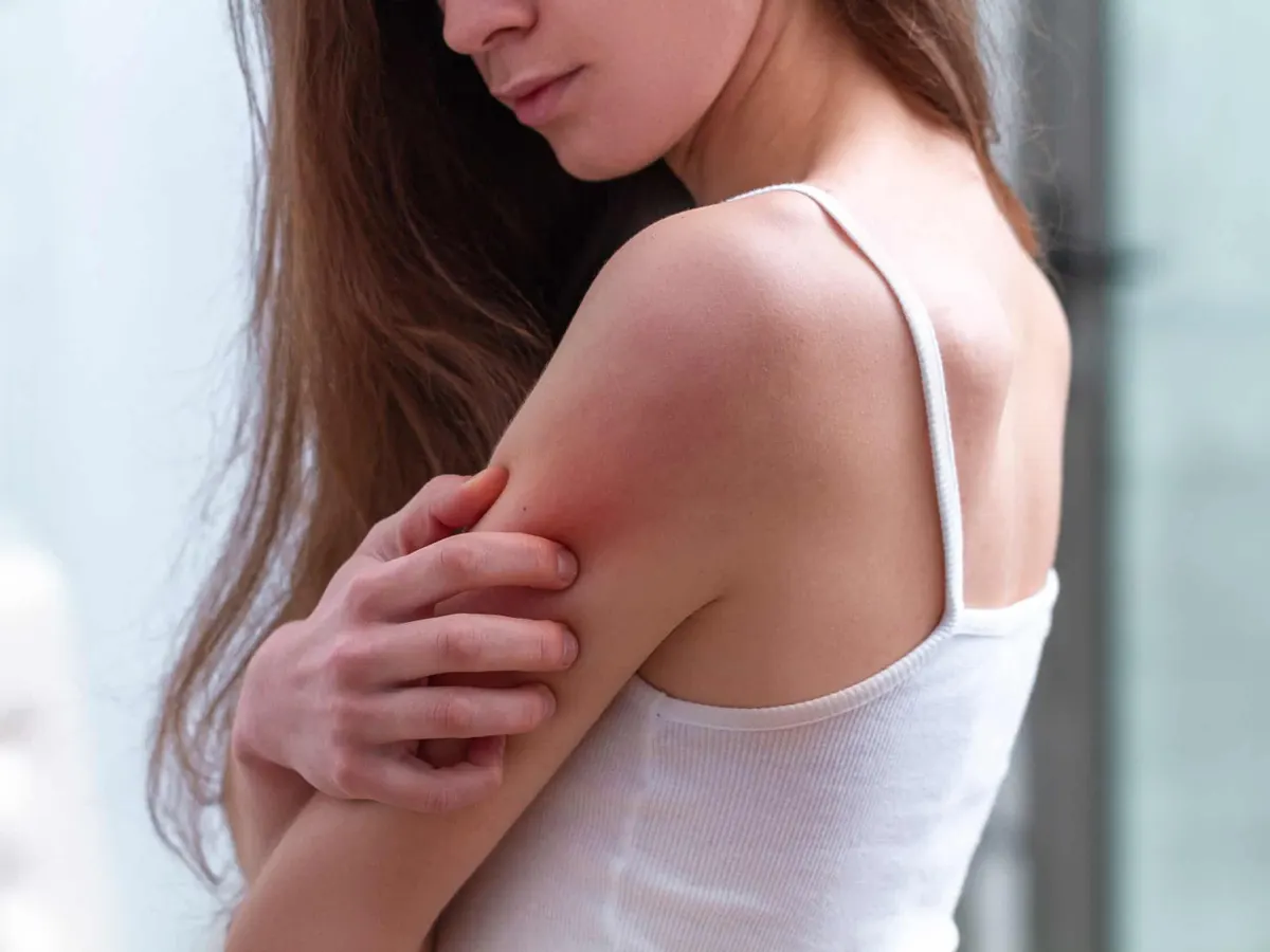 Woman experiencing psoriasis symptoms in Fountain Valley, CA