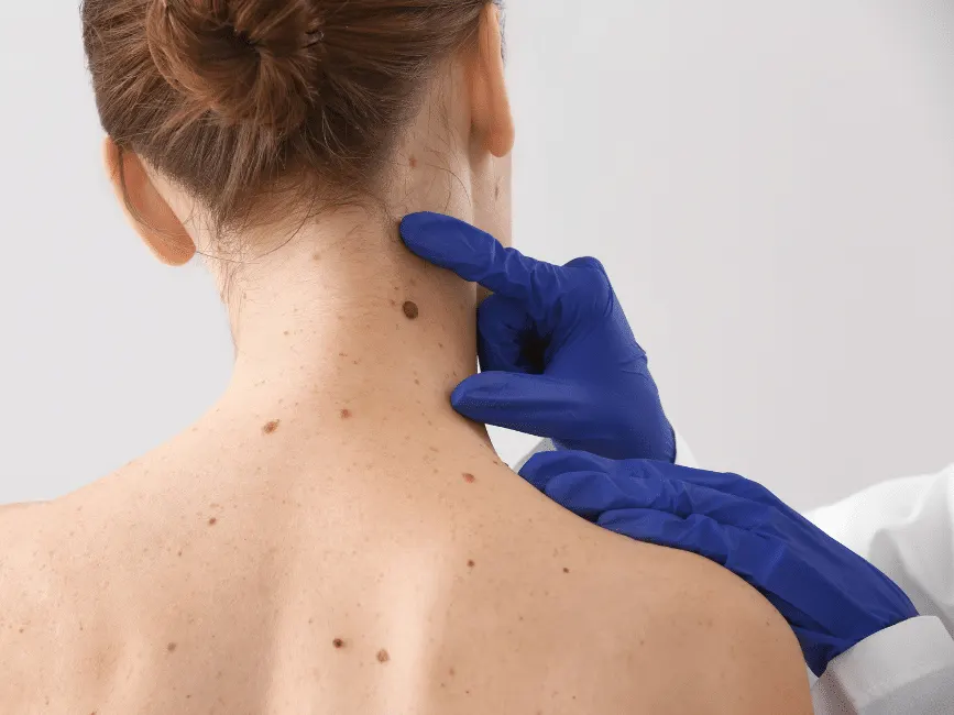 Close up of a patient's back, having some large and dark moles examined for possible melanoma.
