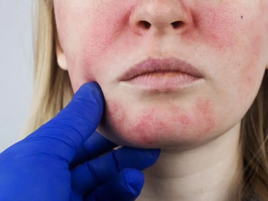 Woman squinting and poking at the bright red rosacea spots on her cheeks, in need of dermatology treatment.