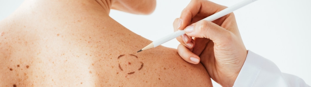 A clinician marking a circle around a mole on a person’s shoulder with a surgical pen
