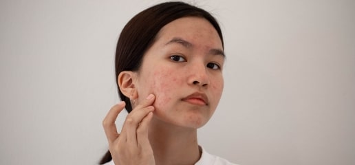 A young woman touching acne breakouts on her cheek
