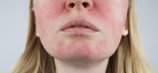 Close-up of a woman’s lower face with red, flushed cheeks and chin