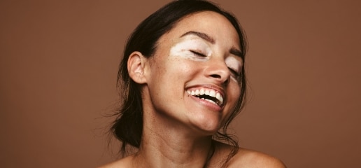 A smiling woman with pale depigmented patches of skin around her eyes