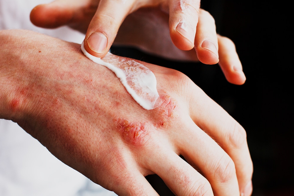 A person applying white cream to red, rough eczema patches on the back of a hand