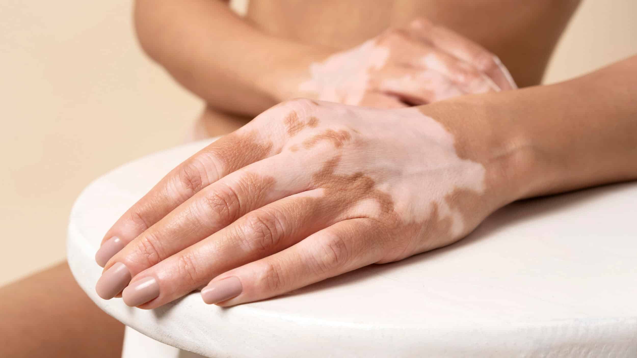 A woman's hands resting on a white table, with pale vitiligo patches on the skin