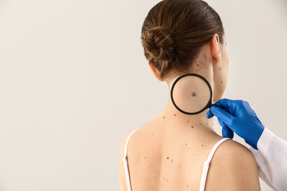 A gloved clinician holding a magnifying glass over a mole on a woman's neck