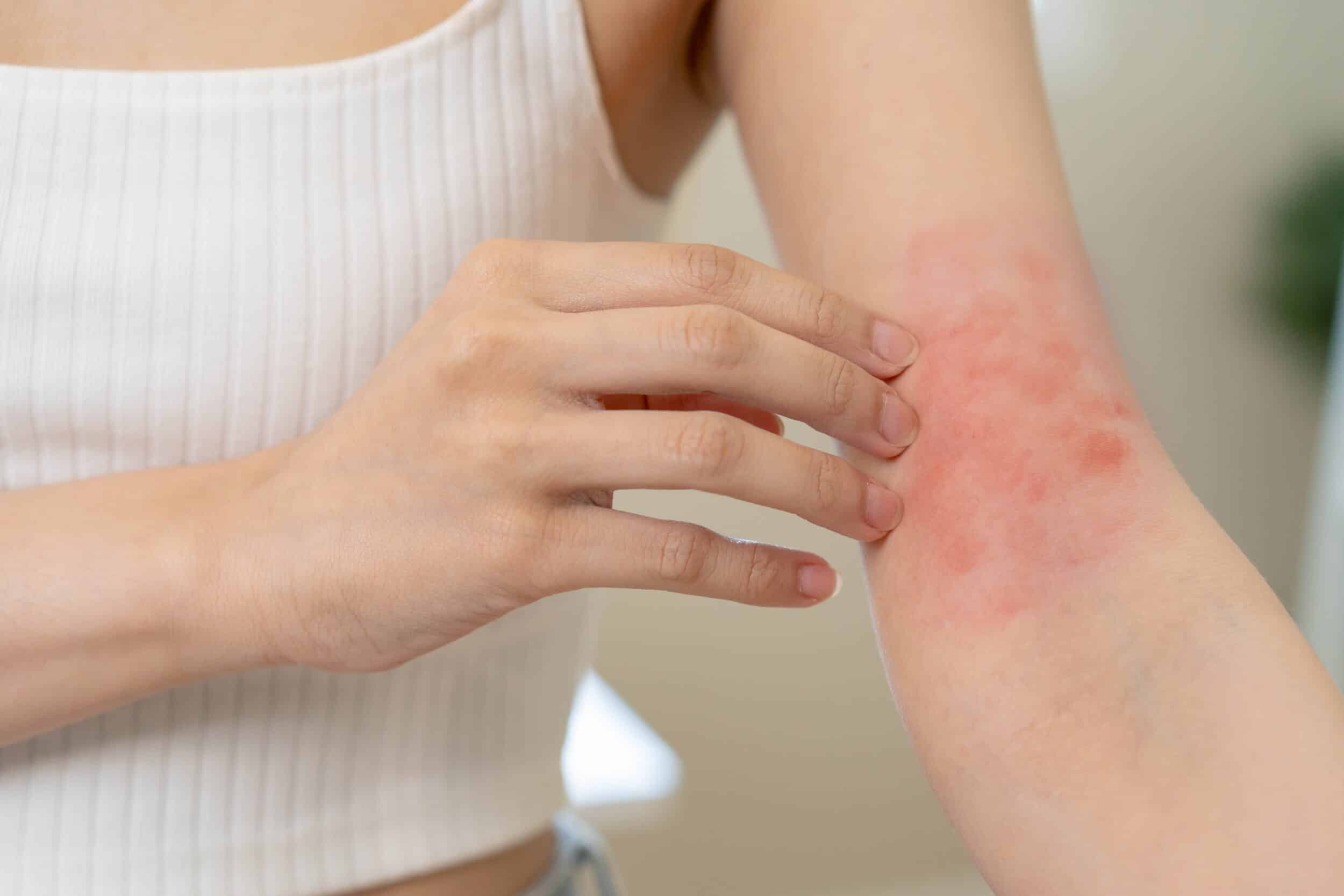 Asian young woman, girl hand in her arm allergy