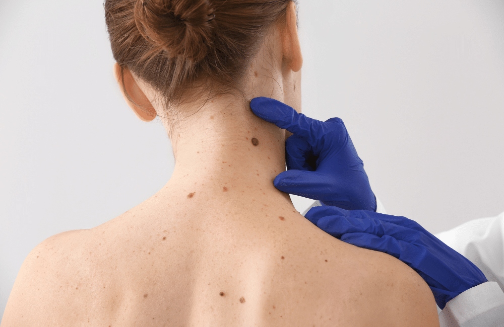 Close up of a patient's back, having some large and dark moles examined for possible melanoma.