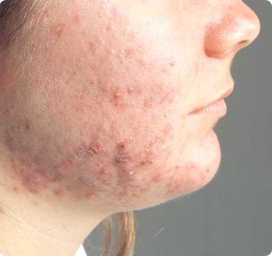 acne of cheek