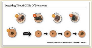 detecting melanoma infographic with illustrations of moles of varying shapes, sizes, and colors