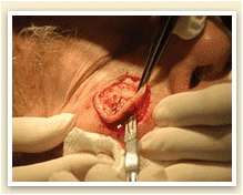mohs micrographic skin cancer surgery being performed on patient’s face just below eye