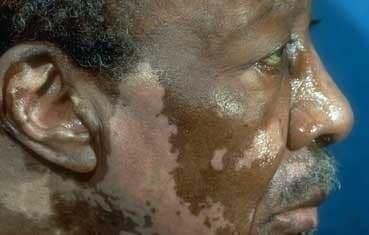 older black gentleman with vitiligo on face