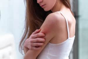 Woman experiencing psoriasis symptoms in Fountain Valley, CA