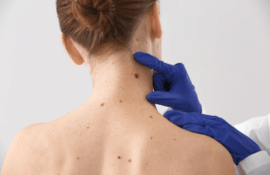 Close up of a patient's back, having some large and dark moles examined for possible melanoma.