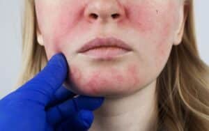 Woman squinting and poking at the bright red rosacea spots on her cheeks, in need of dermatology treatment.